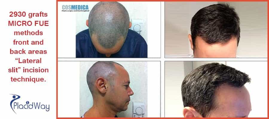 Hair Transplant Procedures Before and After Images in Istanbul, Turkey
